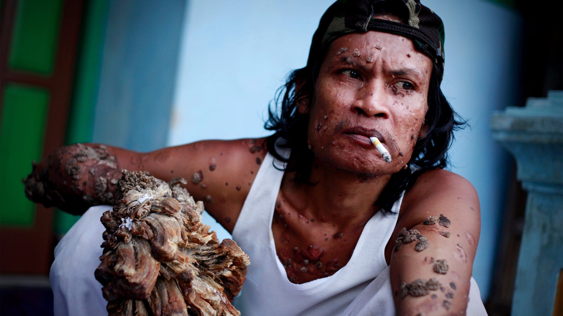 PHOTOS Tree man syndrome